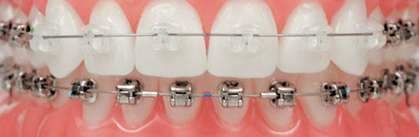 vudent orthodontics